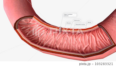 The Stage II duodenal adenoma The Stage II duodenal adenoma 103283321