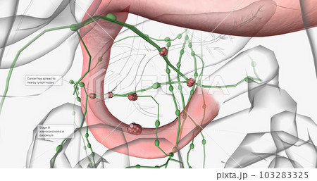 Stage III adenocarcinoma in duodenum 103283325
