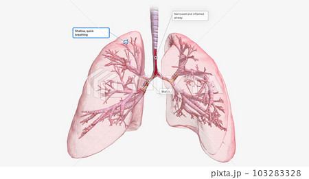 The Narrowed and inflamed airway 103283328