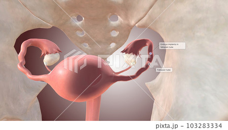Embryo Implantation in Fallopian Tube 103283334