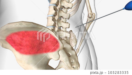 Bone marrow aspiration is a procedure in which a liquid bone marrow sample is collected and tested. 103283335