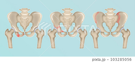 Orthopedics of pelvis and hip fracture anatomy in watercolor style. Orthopedics of pelvis and hip fracture anatomy in watercolor style. 103285056