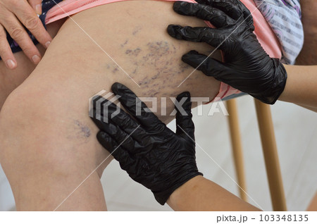 A phlebologist in black gloves conducts a study of veins on the leg of an elderly woman A phlebologist in black gloves conducts a study of veins on the leg of an elderly woman 103348135