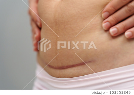 close up belly of woman with c-section scar of caesarean close up belly of woman with c-section scar of caesarean 103353849