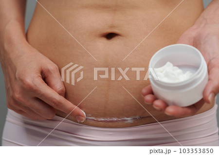 woman putting healing cream in c-section scar of cesarean woman putting healing cream in c-section scar of cesarean 103353850