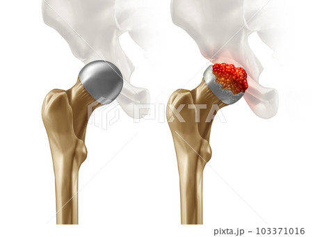 Femoral Head Disease 103371016