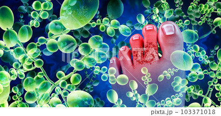 Foot Fungal Infection 103371018
