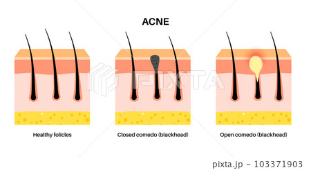 Acne treatment poster 103371903