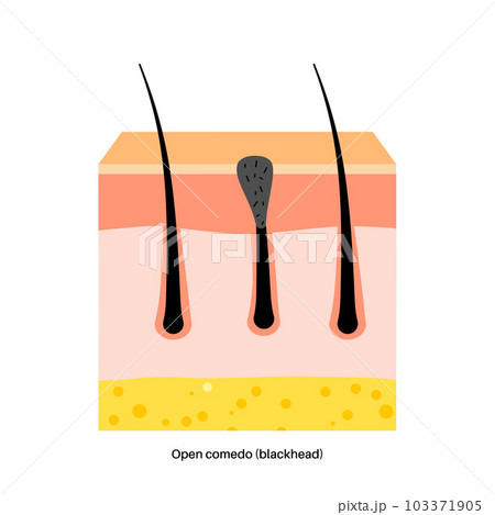 Acne treatment poster Acne treatment poster 103371905