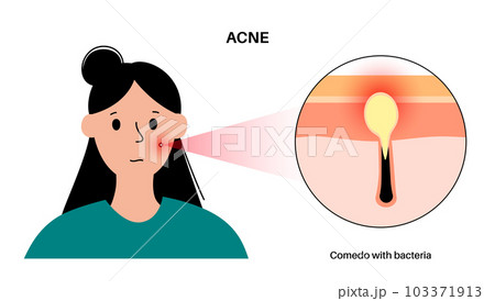 Acne treatment poster Acne treatment poster 103371913