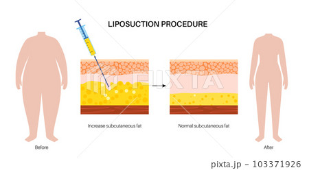 liposuction surgery procedure liposuction surgery procedure 103371926
