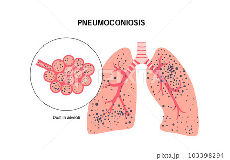 Pneumoconiosis lung disease Pneumoconiosis lung disease 103398294