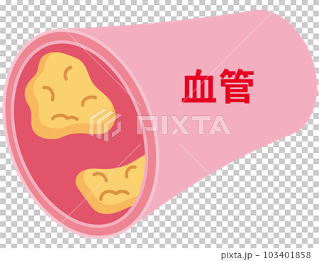 血管に溜まったコレステロール 103401858