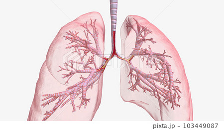 Asthma is a chronic lung disease characterized by inflammation, mucus formation, and narrowing of airways. 103449087
