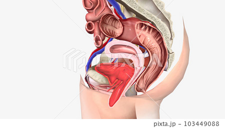 Grade 4 describes a cystocele in which the bulge is entirely past the vaginal opening. 103449088