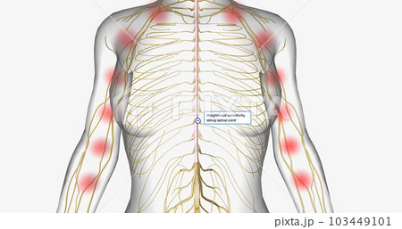 Central sensitization, also called central pain, is a condition associated with the development of chronic pain. Central sensitization, also called central pain, is a condition associated with the development of chronic pain. 103449101