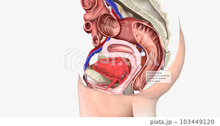 Grade 2 describes a cystocele in which the bulge reaches the level of the hymen, or vaginal opening, without passing it. 103449120