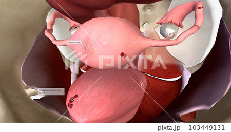 Endometriosis is a condition characterized by the growth of endometrial tissue outside of the uterus. 103449131