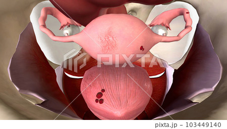Endometriosis is a condition characterized by the growth of endometrial tissue outside of the uterus. 103449140