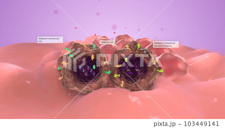 HER 2 Positive Breast Cancer 3d 103449141