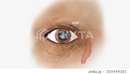 A cataract is the progressive clouding of the lens of the eye accompanied by vision problems. A cataract is the progressive clouding of the lens of the eye accompanied by vision problems. 103449161