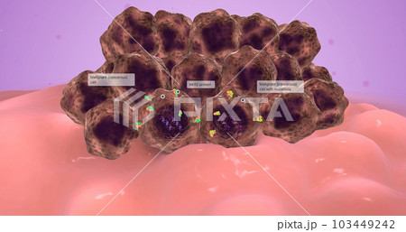 HER 2 Positive Breast Cancer 3d 103449242