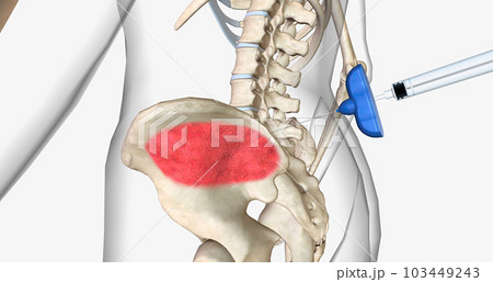 Bone marrow aspiration is a procedure in which a liquid bone marrow sample is collected and tested. Bone marrow aspiration is a procedure in which a liquid bone marrow sample is collected and tested. 103449243