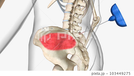 Bone Marrow Biopsy, External view 103449275