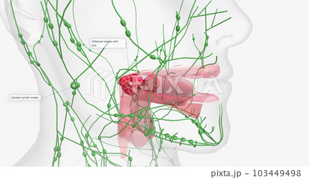 Tonsillitis is caused by a viral or bacterial infection. After an infection, the tonsils can become red and swollen. 103449498