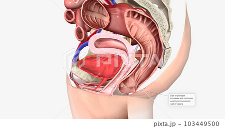 Grade 2 describes a rectocele in which the bulge reaches the level of the hymen, or vaginal opening, without passing it. 103449500