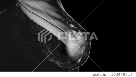 Mammography is a type of X-ray imaging technique used for the screening and diagnosis of breast cancer. 103449517