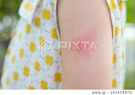 Little girl has skin rash allergy itching and scratching on her arm 103454978