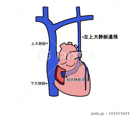 左上大静脈遺残（PLSVC） 103455843