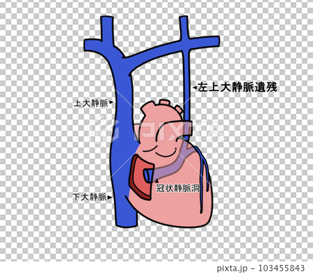 左上大静脈遺残（PLSVC） 103455843