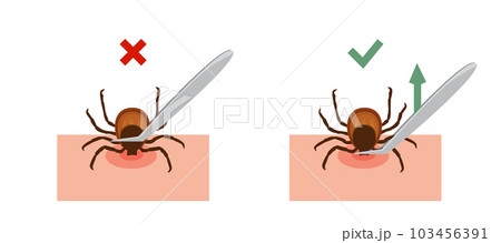 Correct way to remove tick of skin after bite insect correctly, vector illustration. Tips for tick showing safety infographic. Isolated on white background 103456391