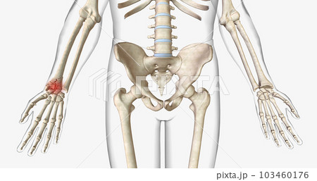 A fracture, often referred to as a broken bone, is an acute injury that causes a partial or complete break through bone. 103460176