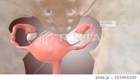 Ectopic pregnancy embryo causes tube rupture Ectopic pregnancy embryo causes tube rupture 103460200