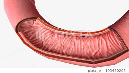 The Duodenal Carcinoma, Stage 0 3d 103460203