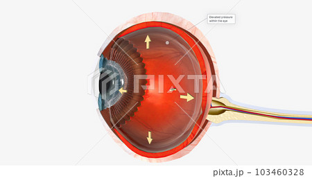 Human eye - glaucoma (eye disease) Human eye - glaucoma (eye disease) 103460328