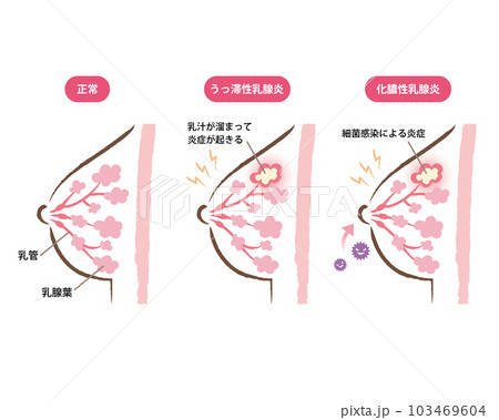 乳腺炎のバストの断面図のイラスト 乳腺炎のバストの断面図のイラスト 103469604
