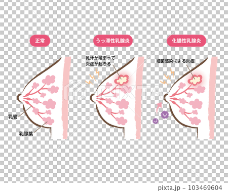 Illustration of a cross section of a mastitis bust Illustration of a cross section of a mastitis bust 103469604