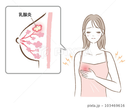 乳腺炎で胸が痛む女性のイラスト 103469616