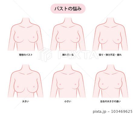 女性のバストの悩みのイラスト(サイズ・かたち) 女性のバストの悩みのイラスト(サイズ・かたち) 103469625
