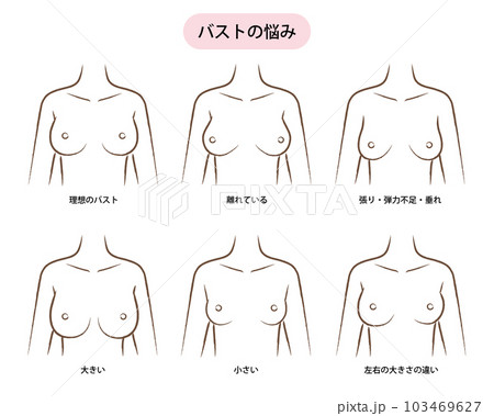 女性のバストの悩みのイラスト（サイズ・かたち） 103469627