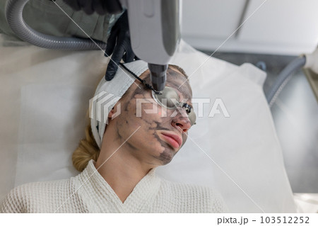 Beautician performs a carbon fiber based skin exfoliation treatment. 103512252