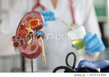 Doctor makes an express urine test using indicator paper in clinic closeup 103531400