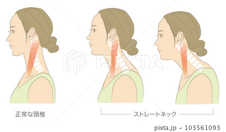 正常な頸椎とストレートネックの女性 正常な頸椎とストレートネックの女性 103561093