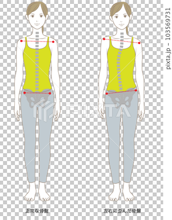 Left and right distortion of the spine and pelvis, illustration of an upright woman 103569731