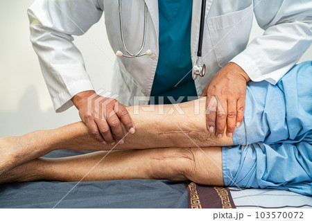 Asian elderly woman patient show her scars surgical total knee joint replacement Suture wound surgery arthroplasty on bed in nursing hospital ward, healthy strong medical concept. Asian elderly woman patient show her scars surgical total knee joint replacement Suture wound surgery arthroplasty on bed in nursing hospital ward, healthy strong medical concept. 103570072