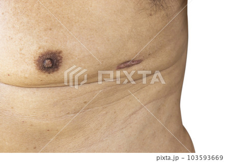 Close up of Scar caused by abdominal aorta surgery in elderly men. Cyanotic keloid Scars caused by abdominal surgery and suturing. skin imperfections or defects. 103593669